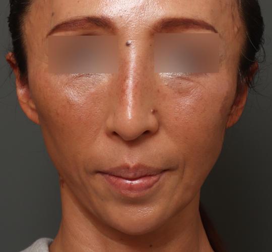 50代女性の人中短縮（リップリフト） Before 症例写真