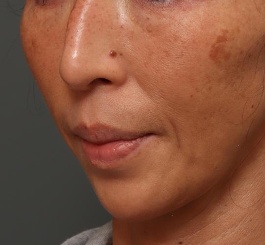 50代女性の人中短縮(リップリフト) Before 症例写真