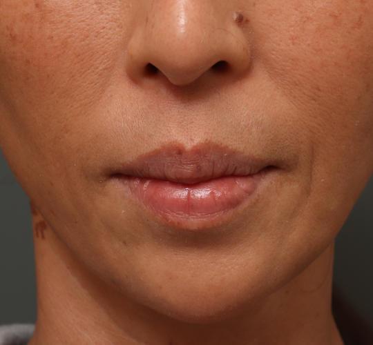 50代女性の人中短縮（リップリフト） Before 症例写真