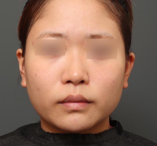 20代女性の人中短縮(リップリフト) After 症例写真