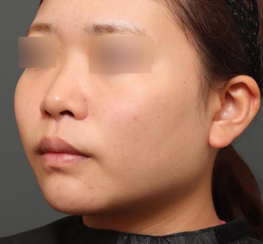 20代女性の人中短縮(リップリフト) After 症例写真