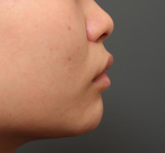 20代女性の人中短縮(リップリフト) After 症例写真