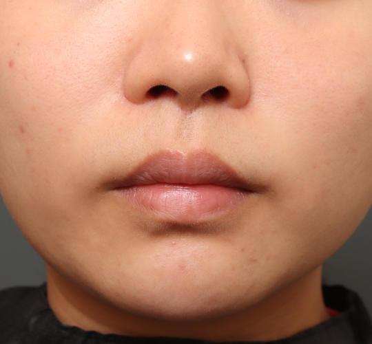 20代女性の人中短縮(リップリフト) After 症例写真