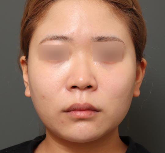 20代女性の人中短縮(リップリフト) Before 症例写真