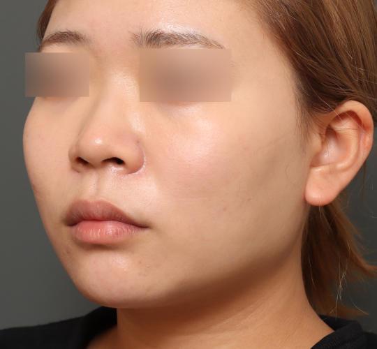 20代女性の人中短縮(リップリフト) Before 症例写真