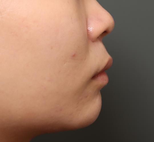 20代女性の人中短縮(リップリフト) Before 症例写真