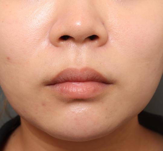 20代女性の人中短縮(リップリフト) Before 症例写真