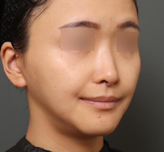 30代女性の人中短縮（リップリフト） After 症例写真