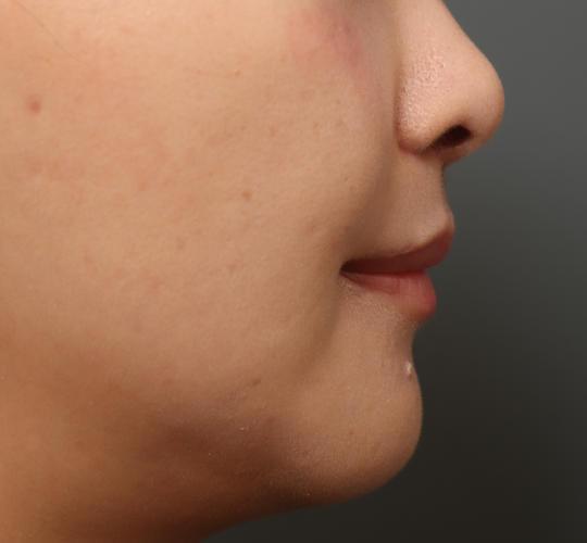 30代女性の人中短縮（リップリフト） After 症例写真