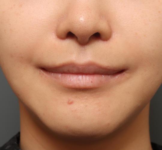 30代女性の人中短縮（リップリフト） After 症例写真