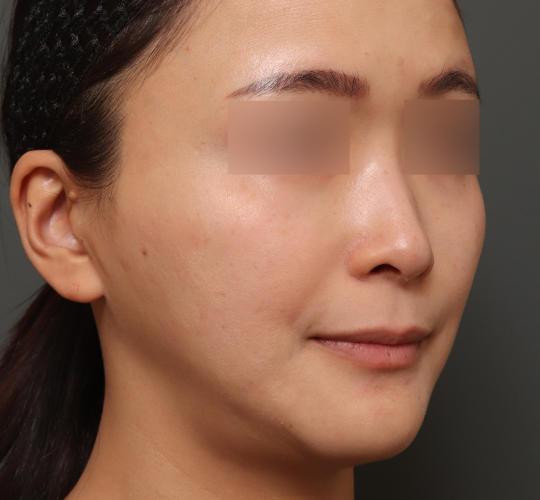 30代女性の人中短縮（リップリフト） Before 症例写真