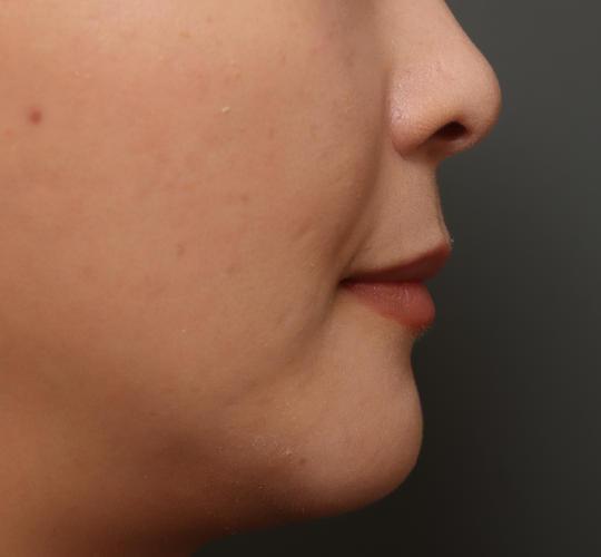 30代女性の人中短縮（リップリフト） Before 症例写真