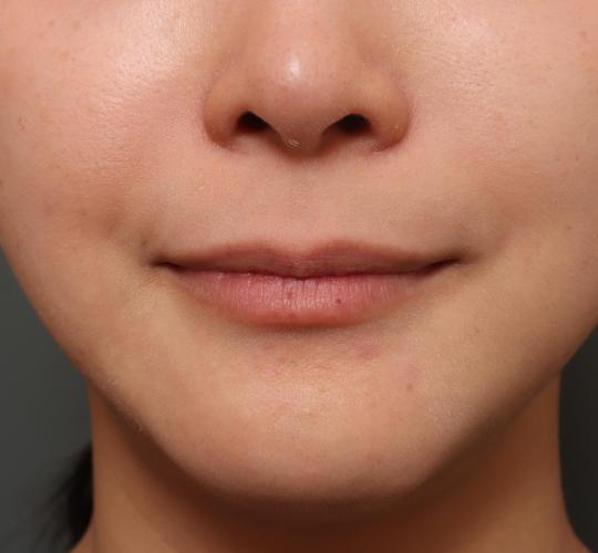 30代女性の人中短縮（リップリフト） Before 症例写真