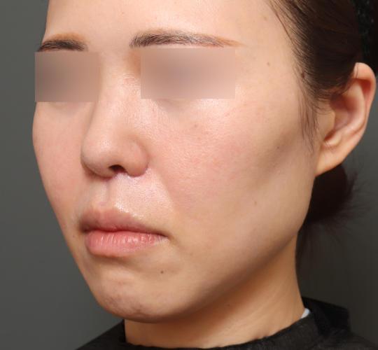 40代女性の人中短縮（リップリフト） After 症例写真