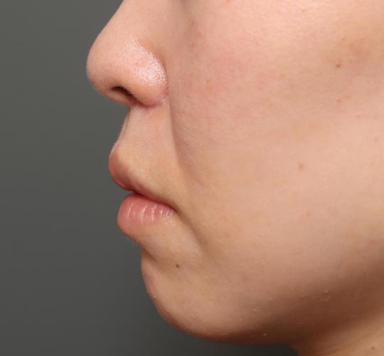 40代女性の人中短縮（リップリフト） After 症例写真