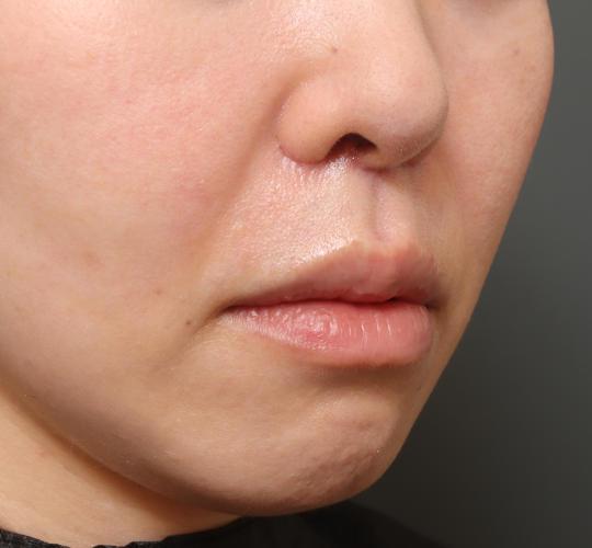 40代女性の人中短縮（リップリフト） After 症例写真