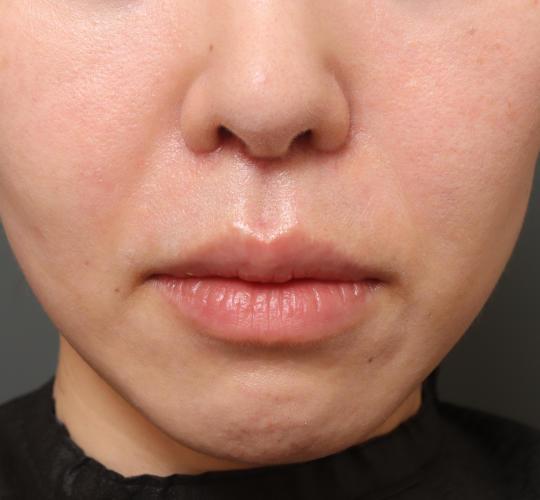 40代女性の人中短縮(リップリフト) After 症例写真