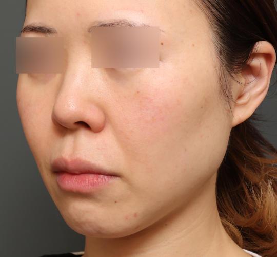40代女性の人中短縮（リップリフト） Before 症例写真