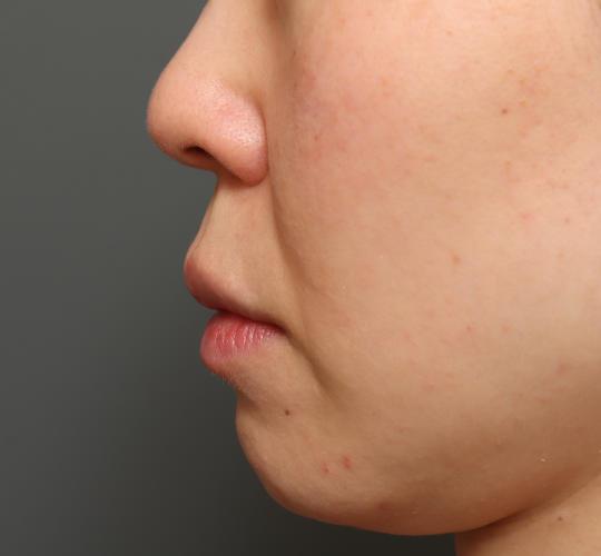 40代女性の人中短縮（リップリフト） Before 症例写真
