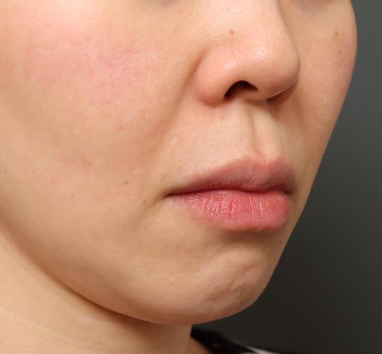 40代女性の人中短縮（リップリフト） Before 症例写真