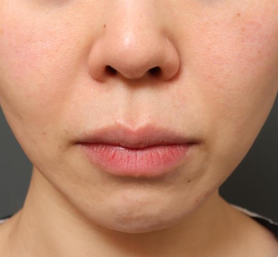 40代女性の人中短縮(リップリフト) Before 症例写真