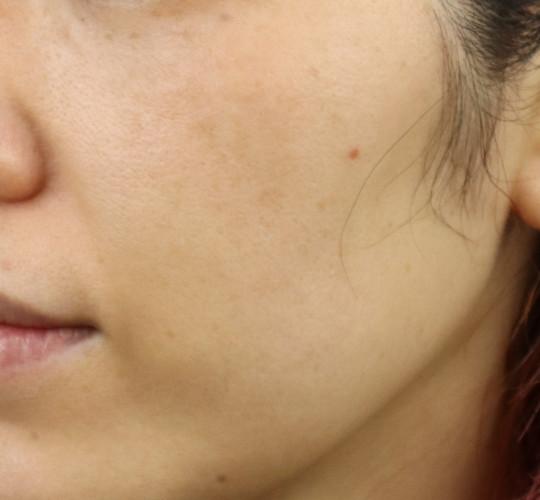 40代女性のフォトRF(SR) After 症例写真