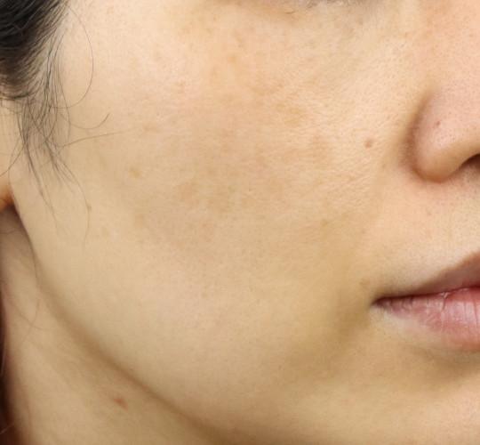 40代女性のフォトRF(SR) After 症例写真