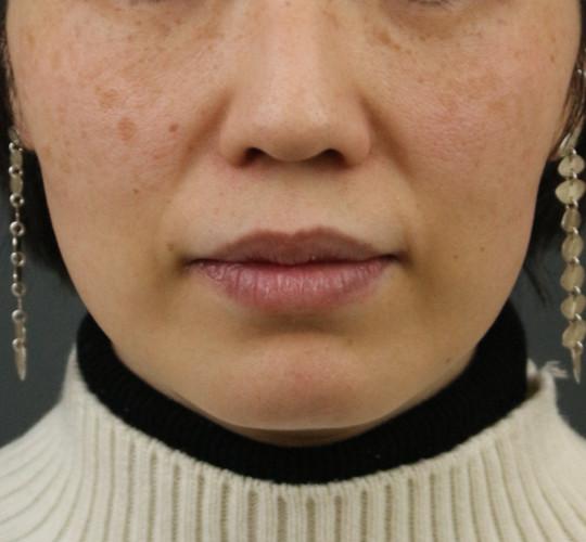 40代女性のシミ・そばかす Before 症例写真