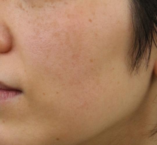 40代女性のフォトRF(SR) Before 症例写真