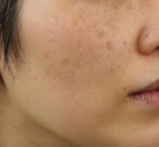 40代女性のフォトRF(SR) Before 症例写真