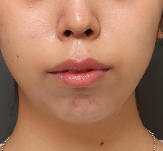 20代女性の唇・口元の整形 After 症例写真