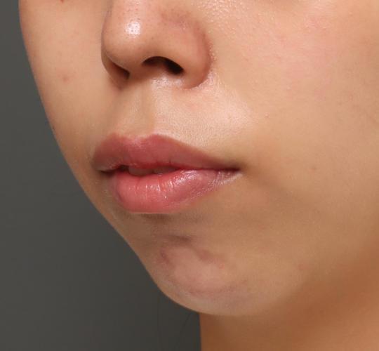 20代女性の人中短縮ボトックス After 症例写真