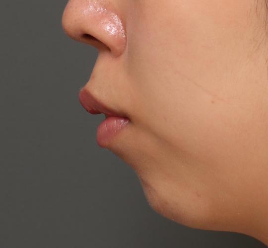 20代女性の人中短縮ボトックス After 症例写真