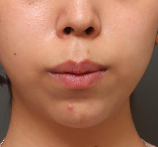 20代女性の唇・口元の整形 Before 症例写真