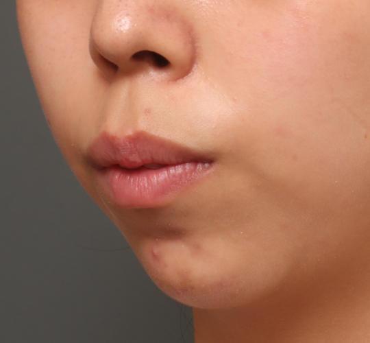 20代女性の人中短縮ボトックス Before 症例写真