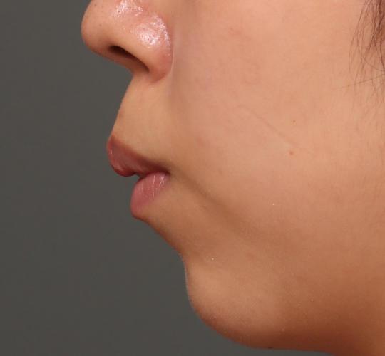 20代女性の人中短縮ボトックス Before 症例写真