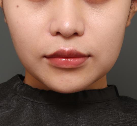 20代女性の人中短縮（リップリフト） After 症例写真