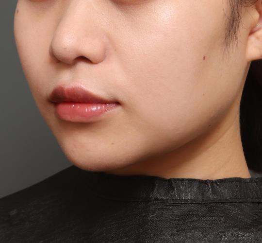20代女性の人中短縮（リップリフト） After 症例写真