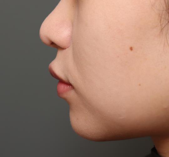 20代女性の人中短縮（リップリフト） After 症例写真