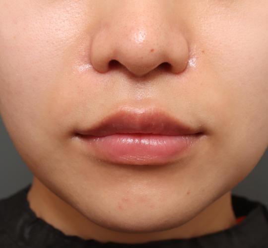 20代女性の人中短縮（リップリフト） After 症例写真