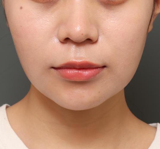 20代女性の人中短縮（リップリフト） Before 症例写真