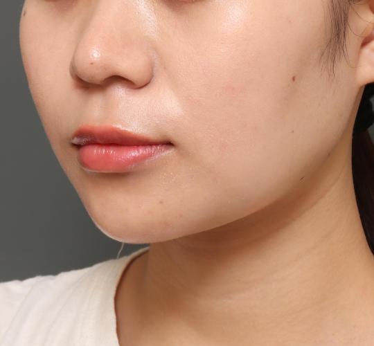 20代女性の人中短縮（リップリフト） Before 症例写真