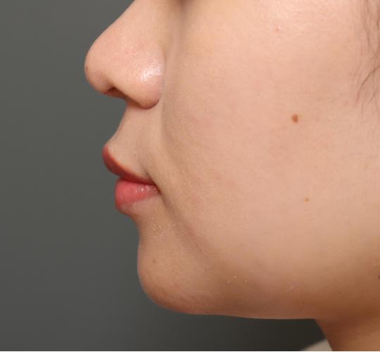 20代女性の人中短縮（リップリフト） Before 症例写真
