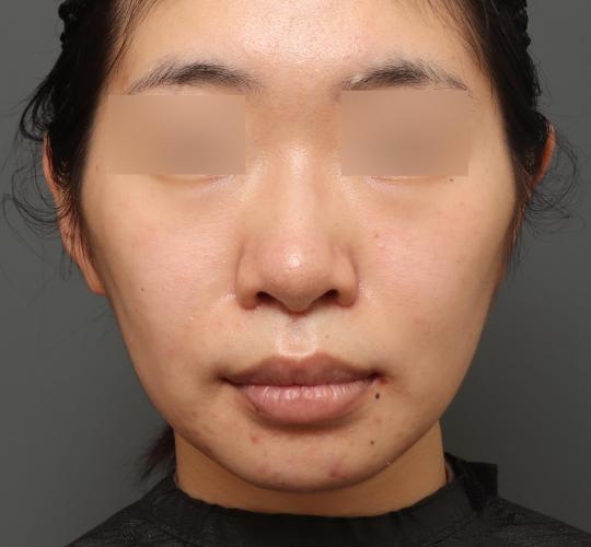 20代女性の人中短縮(リップリフト) After 症例写真