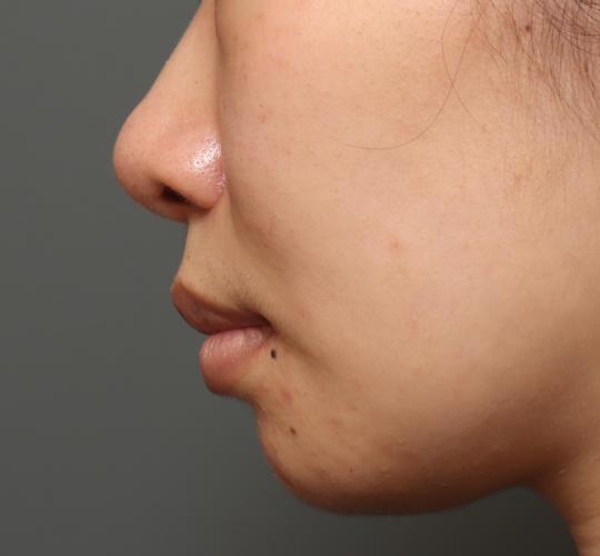 20代女性の人中短縮(リップリフト) After 症例写真