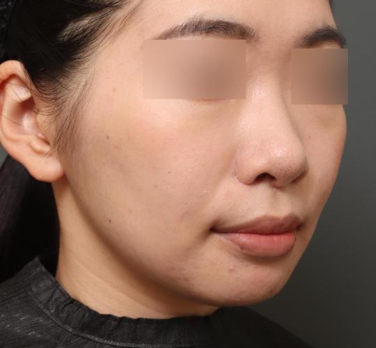 20代女性の人中短縮(リップリフト) After 症例写真