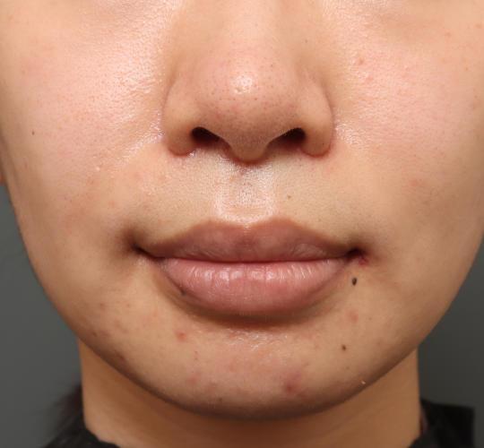 20代女性の人中短縮(リップリフト) After 症例写真
