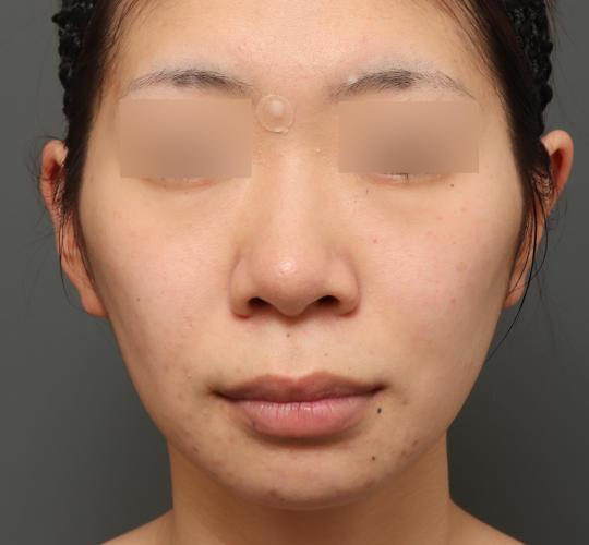 20代女性の人中短縮(リップリフト) Before 症例写真