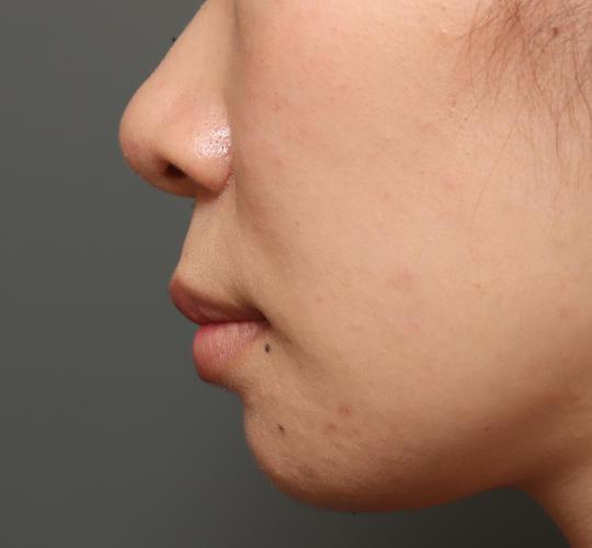 20代女性の人中短縮(リップリフト) Before 症例写真