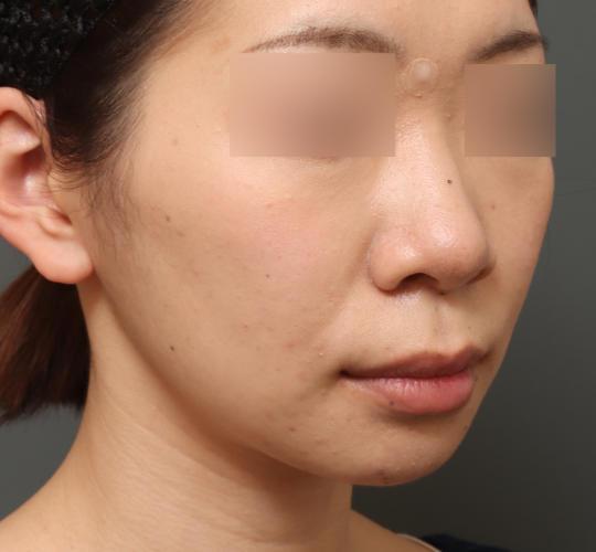 20代女性の人中短縮(リップリフト) Before 症例写真